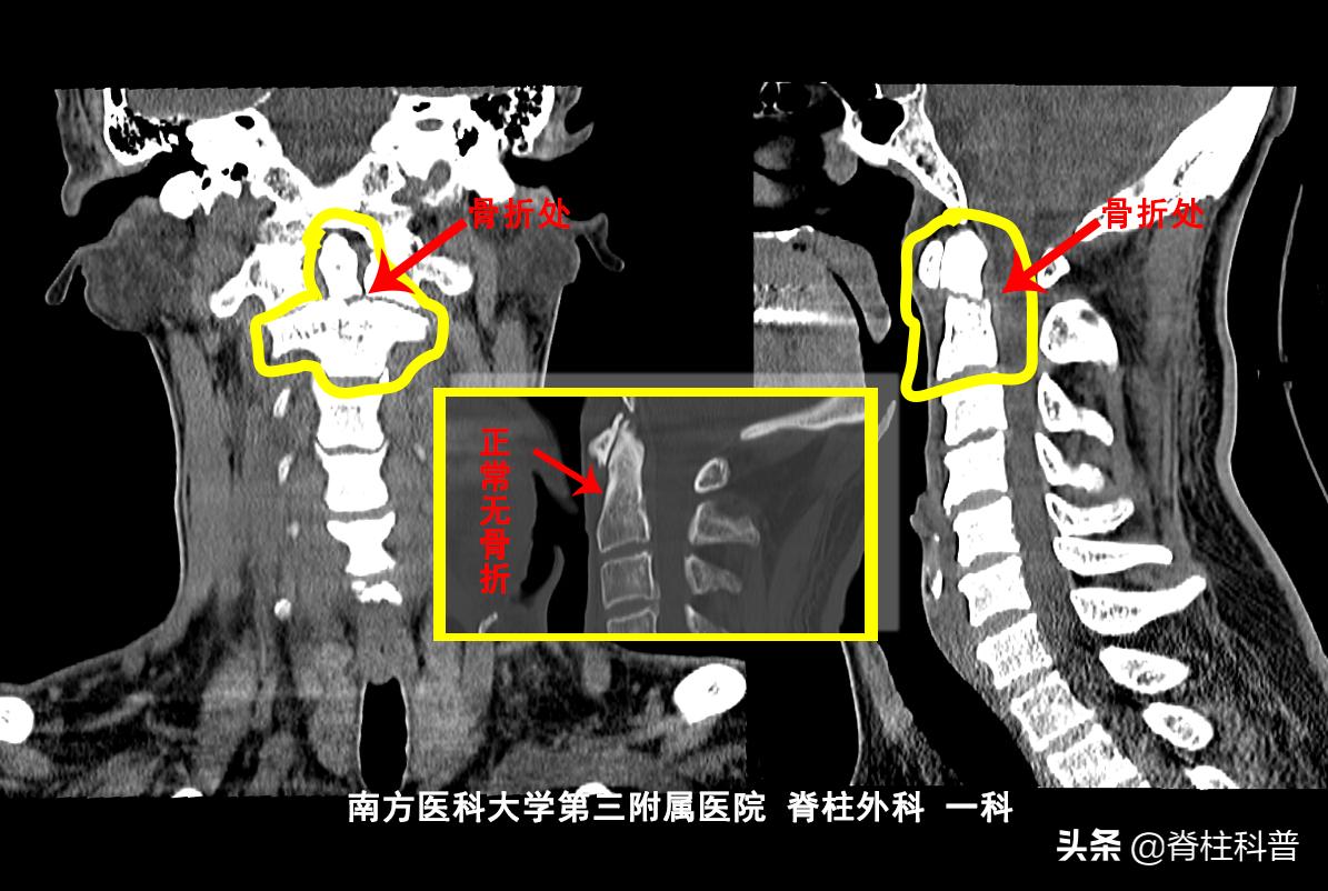逃过了医院手术的一劫,halovest支架