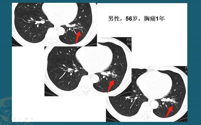 新冠肺部感染应对,新冠肺癌抗癌