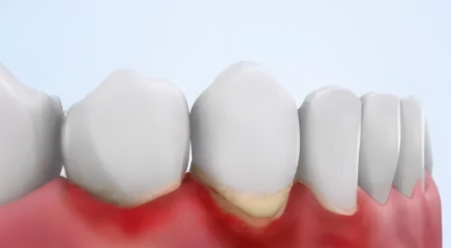 牙齿咬东西酸软无力用什么牙膏,牙齿酸软恢复小妙招真的有用吗