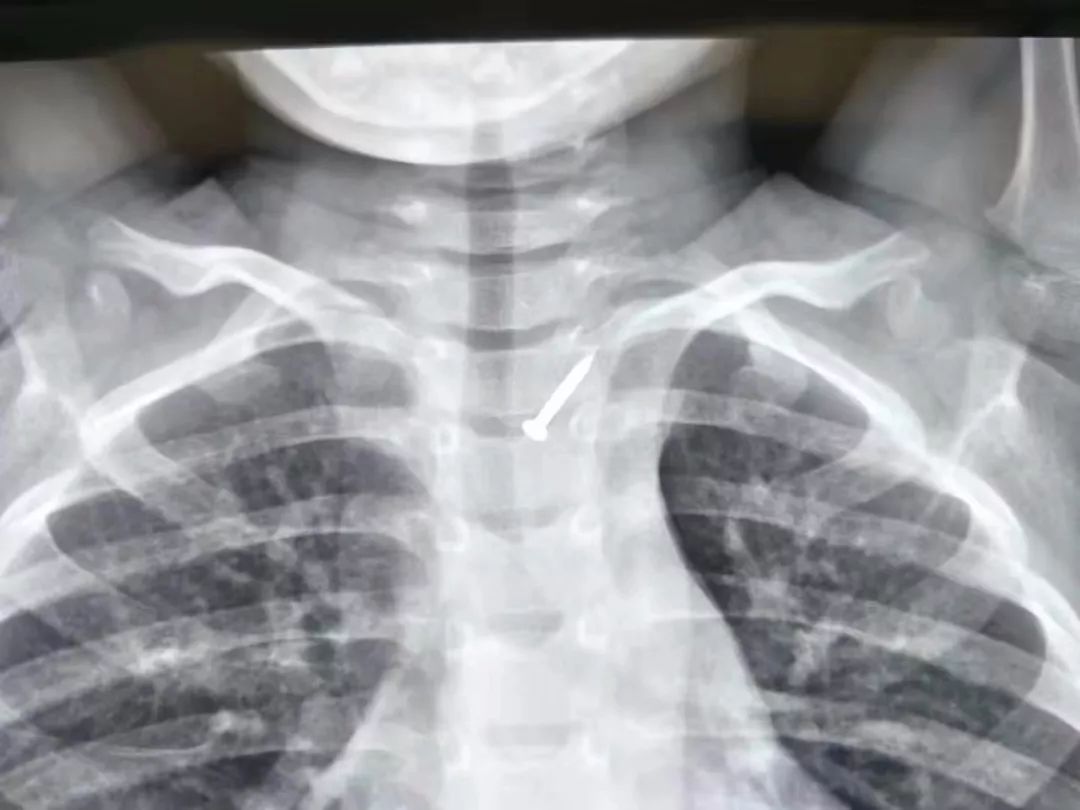 吞下“网线钉”浑然不觉，福州闽侯4岁男孩命悬一线