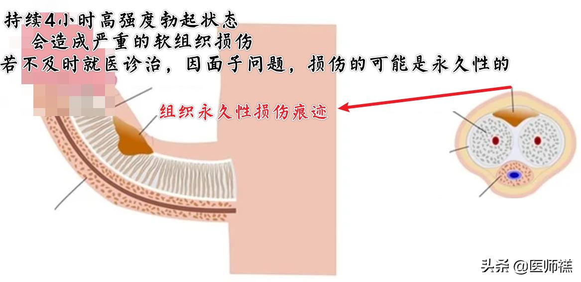 蓝色小药丸你用对了吗,第一次吃蓝色小药丸有副作用吗