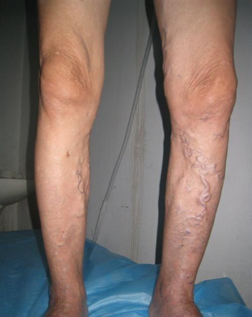 跷二郎腿会血管不通吗,跷二郎腿会影响动脉血流吗