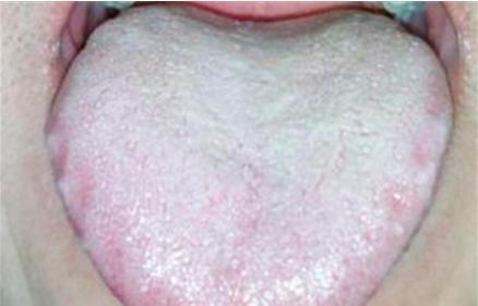 关于舌苔知道身体健康的视频,舌苔是健康的晴雨表吗