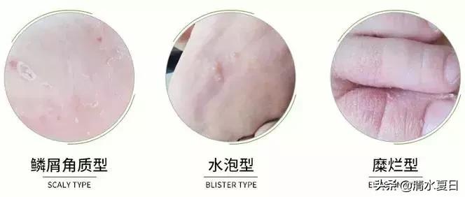 夏天治脚臭最好的方法,除脚臭好物推荐瞬间除臭