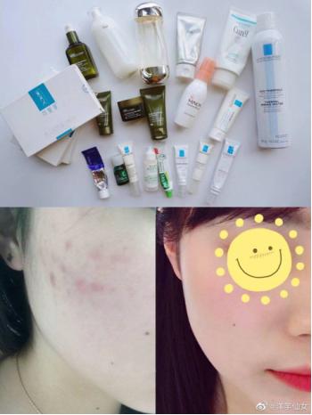 女生敏感肌去闭口推荐什么面霜,敏感肌女生怎么办
