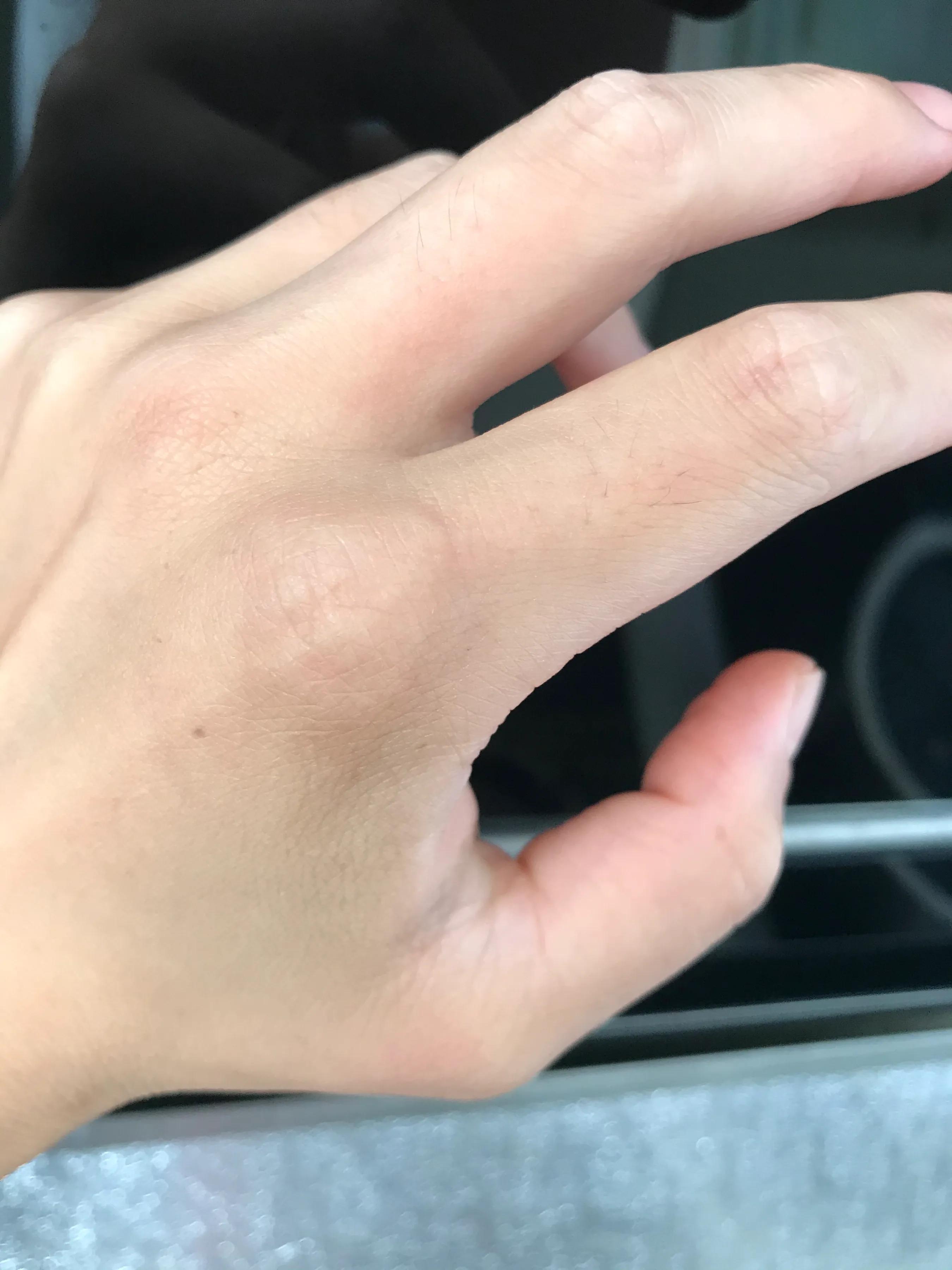 烫伤口红肿没起泡痛痒怎么回事,开水烫伤怎么处理不会留疤