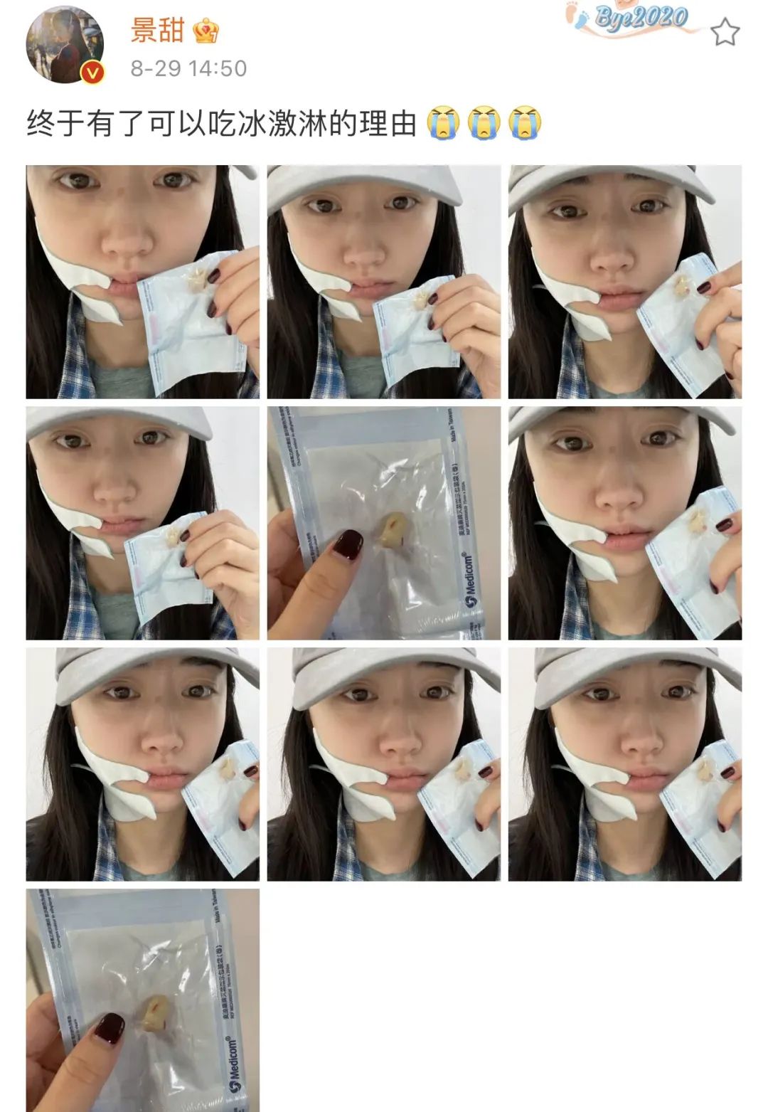 景甜素颜曝光认不出，自拍双眼皮疤痕明显，曾大方承认自己整容