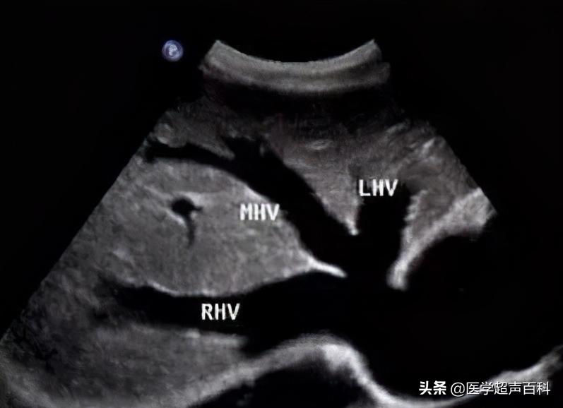 肝上有淤血怎么治疗吃中药,肝淤血的超声诊断标准