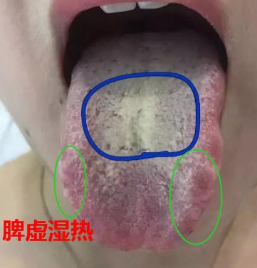 脾气虚和脾阳虚脾虚湿盛的区别,脾虚百病生脾虚有哪些表现