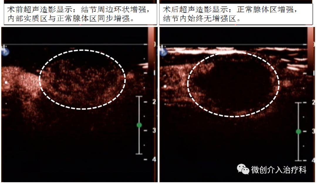 哈尔滨微创消融甲状腺结节哪家好,甲状腺结节微创消融术的过程