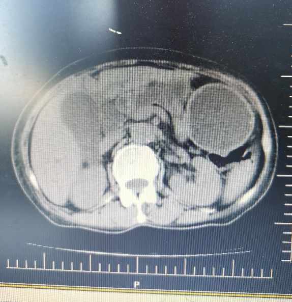 中医治疗胰腺癌有希望吗,中医能够治愈胰腺癌案例