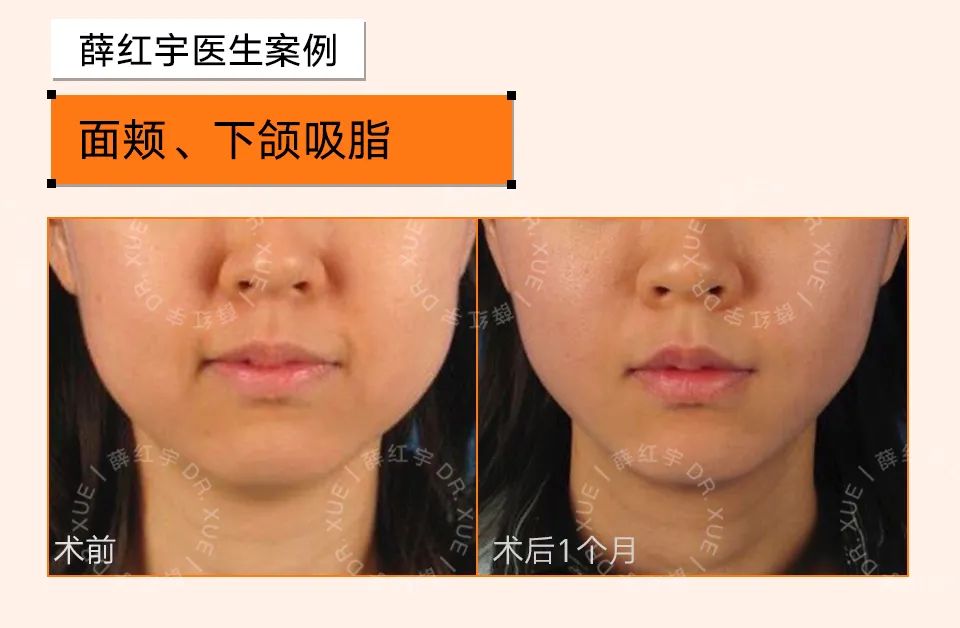 脾胃好了法令纹会改善吗,面部瑜伽能改善法令纹吗