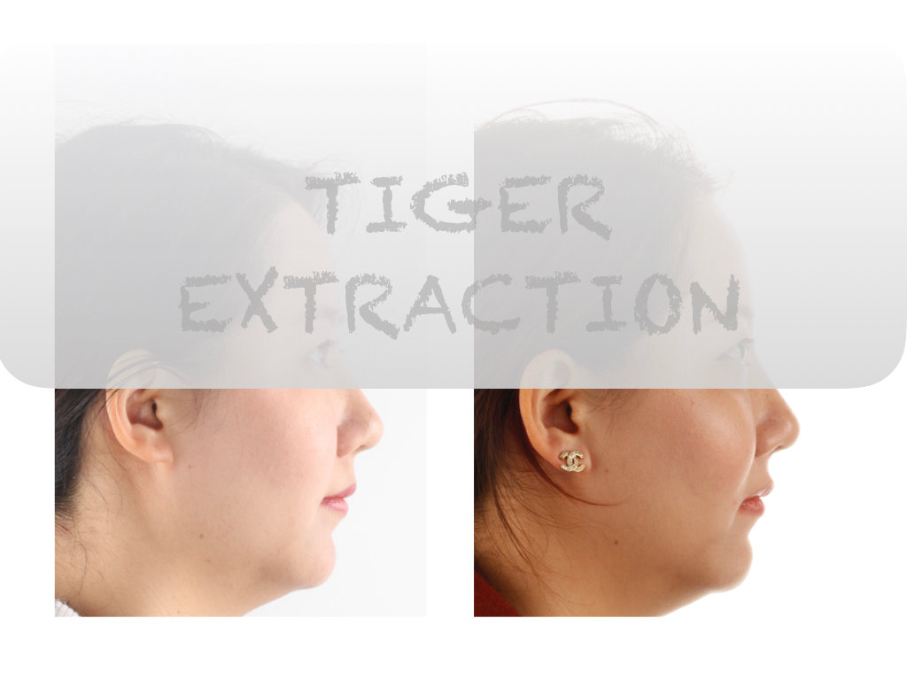 正畸医生邰怡的作品,南京牙齿矫正邰医生