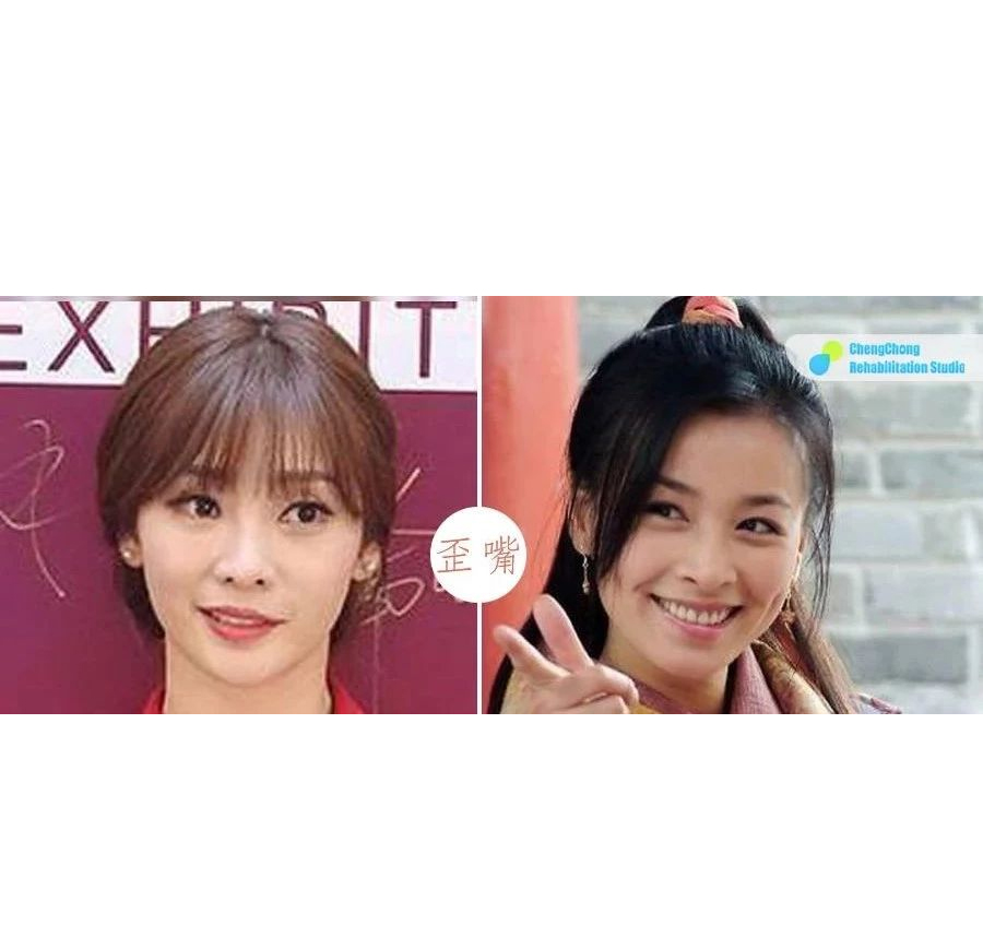 先天性笑起来嘴歪怎么矫正,一直笑起来嘴歪怎么自己矫正