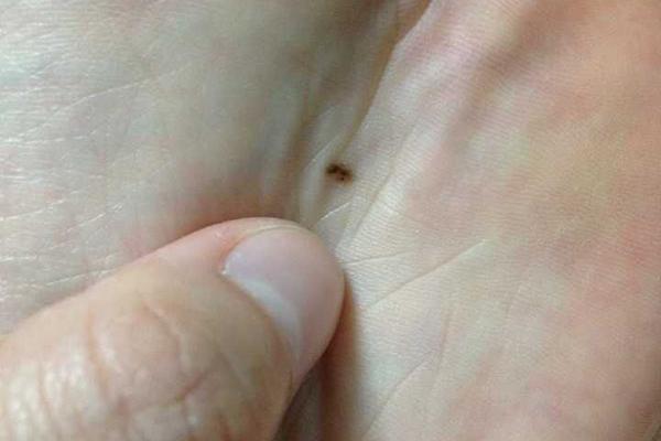 身上出现这几种痣要注意了,身上这两类痣可能是大病信号