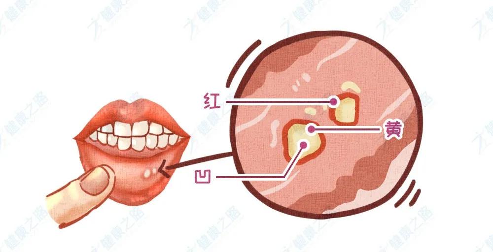 常见口腔溃疡症状及治疗方法,常见口腔溃疡的症状及治疗方法
