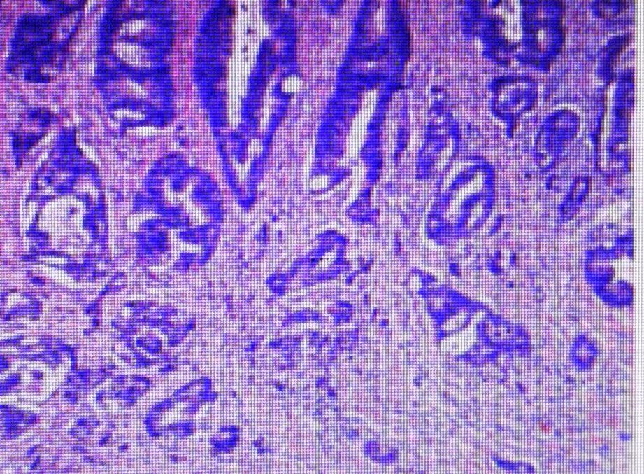 直肠癌转移肺部ct报告单怎样提示,直肠癌转移到肝肺部还能活多久