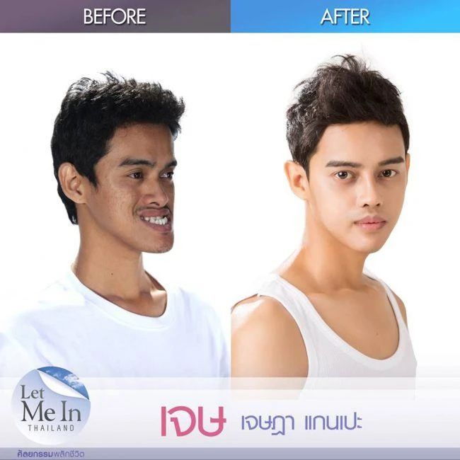 泰国最逆天的不是变性，而是堪比换头的整形