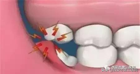 拔智齿不长平咋办,拔第二磨牙不拔智齿可以吗