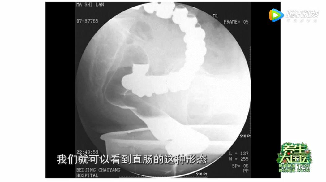 有便意又拉不出，肛门坠胀不止是痔疮作怪，这两项检查找出病因
