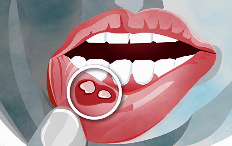 如何快速缓解口腔溃疡实在太疼了,特别严重的口腔溃疡最快解决方法