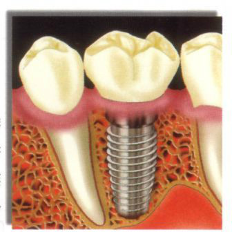 各类假牙价格,最便宜的假牙多少钱一颗