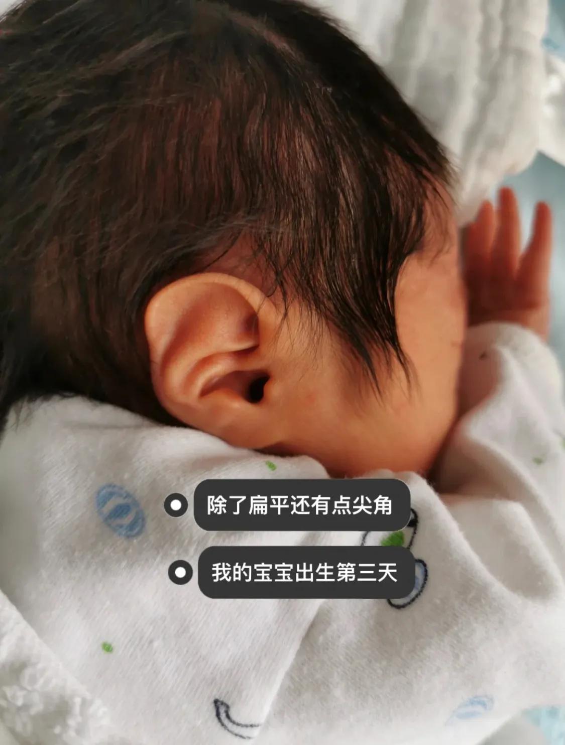宝宝出生耳廓畸形但是听力正常,刚出生宝宝畸形耳朵图片