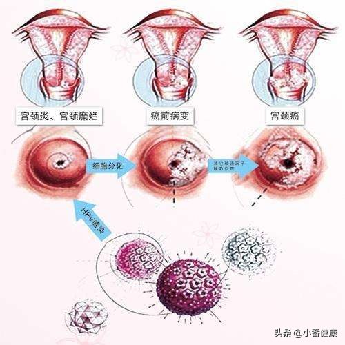 女性长期便秘，要把女性特有的一种癌症，宫颈癌考虑进去！