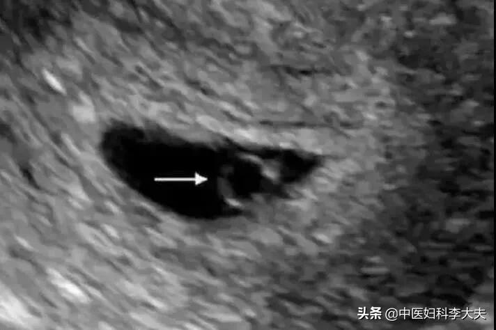 怀孕以后检查出空孕囊,明明怀孕了却查不出来孕囊