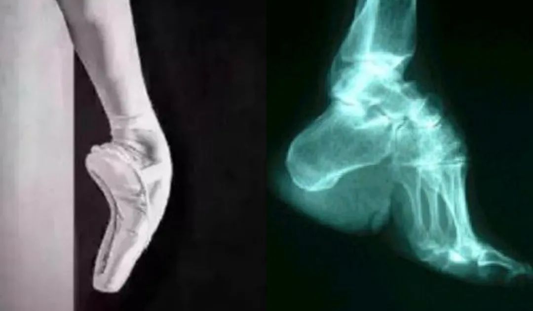 芭蕾脚背有多可怕,练芭蕾对足弓会受影响吗