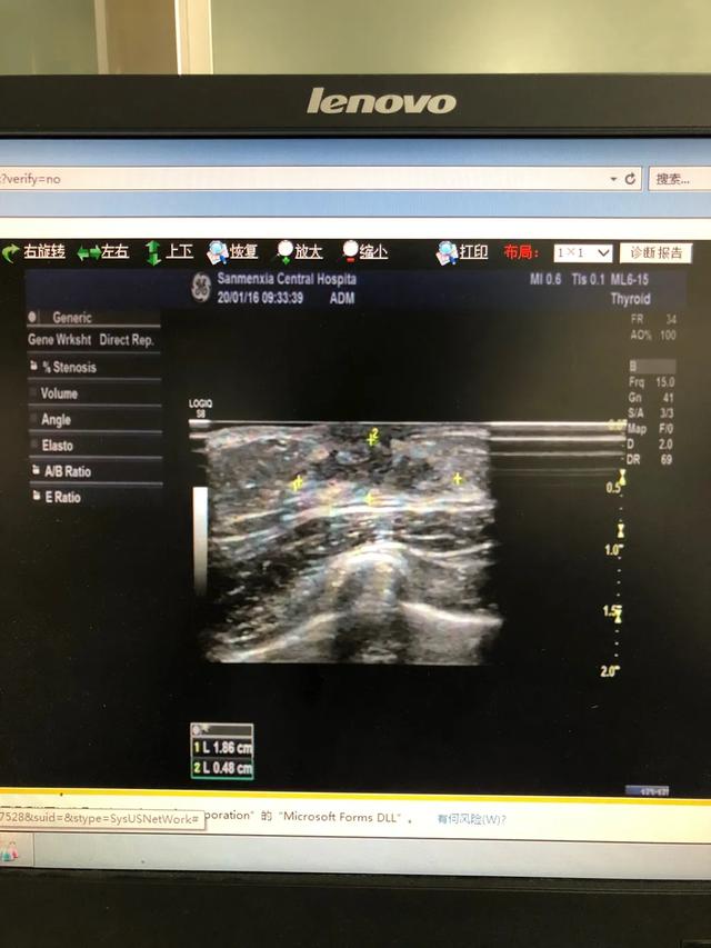 儿童性早熟要做哪些检查？怎么根据这些指标判断真性还是假性？