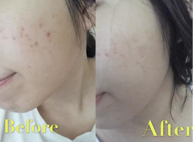 光子嫩肤脱毛仪的危害和禁忌,光子嫩肤注意事项文字