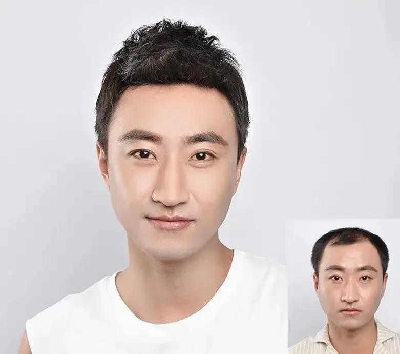 男生发际线太高可以烫发吗,发型设计男生发际线高