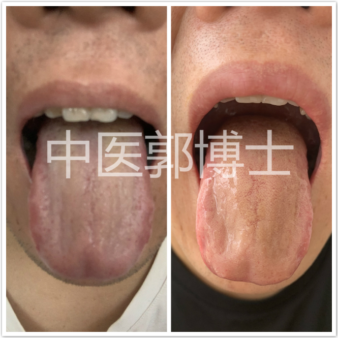 因借酒消愁，左上腹隐痛，腹胀腹泻，中药配合心理疏导，效果更好