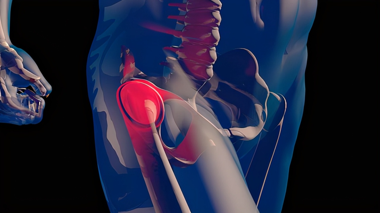 股骨头坏死到底是怎么回事啊,股骨头坏死究竟能不能治好