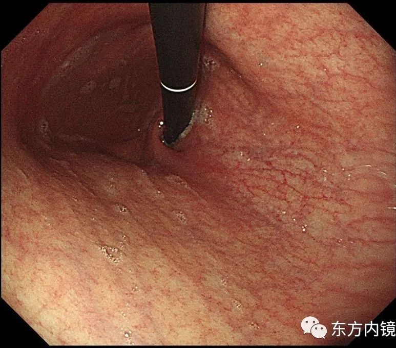 慢性浅表萎缩性胃炎怎么是轻度的,慢性浅表性胃炎中医治疗