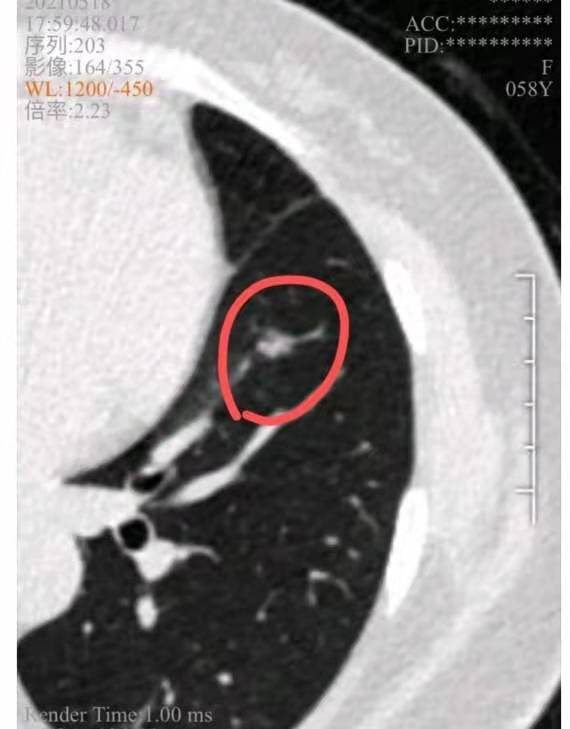 肺结节8mm磨玻璃结节建议手术,肺结节6mm磨玻璃结节已观察2年了