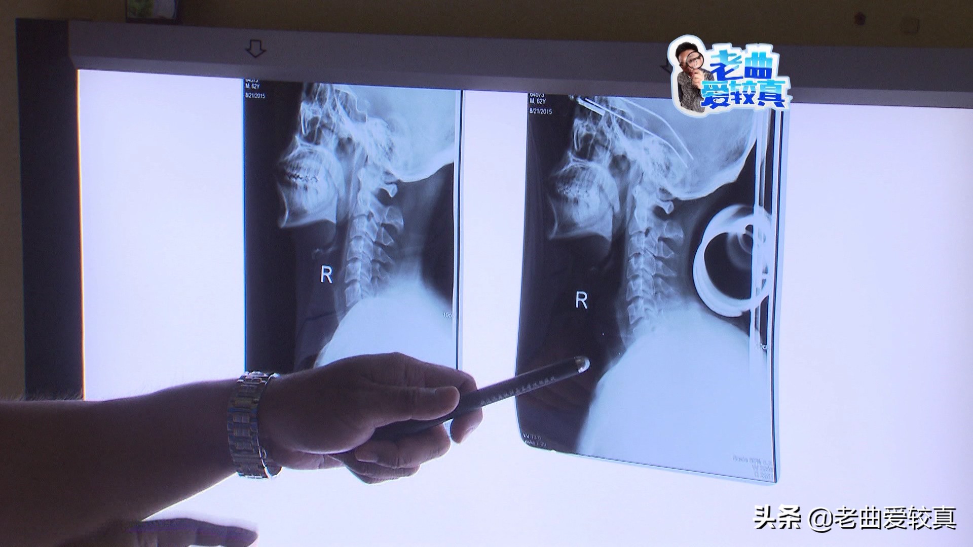 枕酒瓶子治颈椎,枕艾草可以治疗颈椎病吗