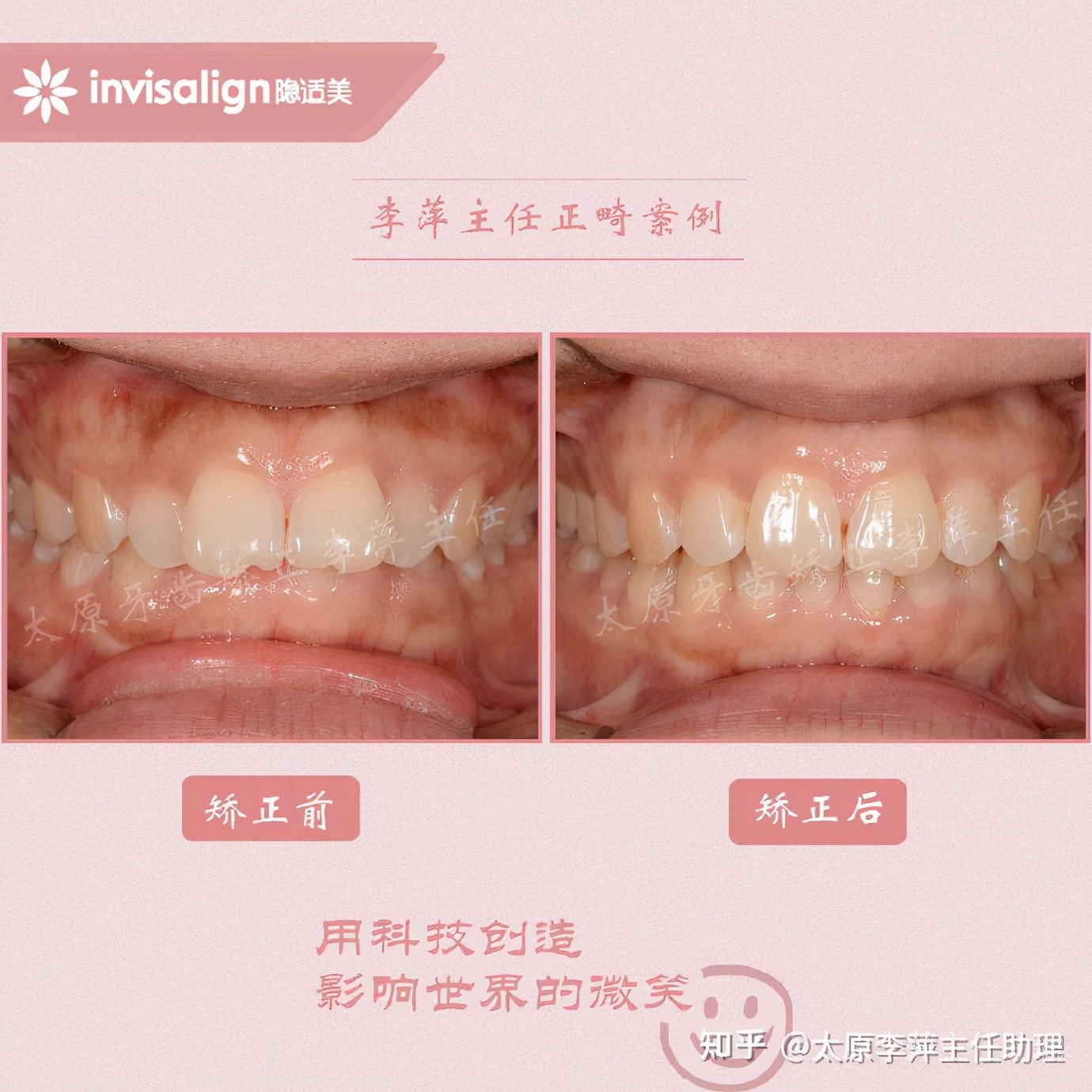 重度拥挤矫正牙齿适合隐形牙套吗,广州成人牙齿矫正推荐隐形牙套