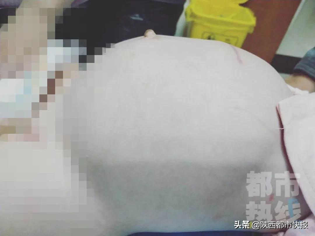 婴儿腹部有肿块,上海8个月女婴腹水肿胀如球