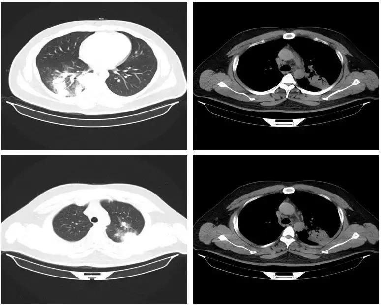 怎样确诊肺部真菌感染,侵袭性肺真菌病的确诊标准有哪些