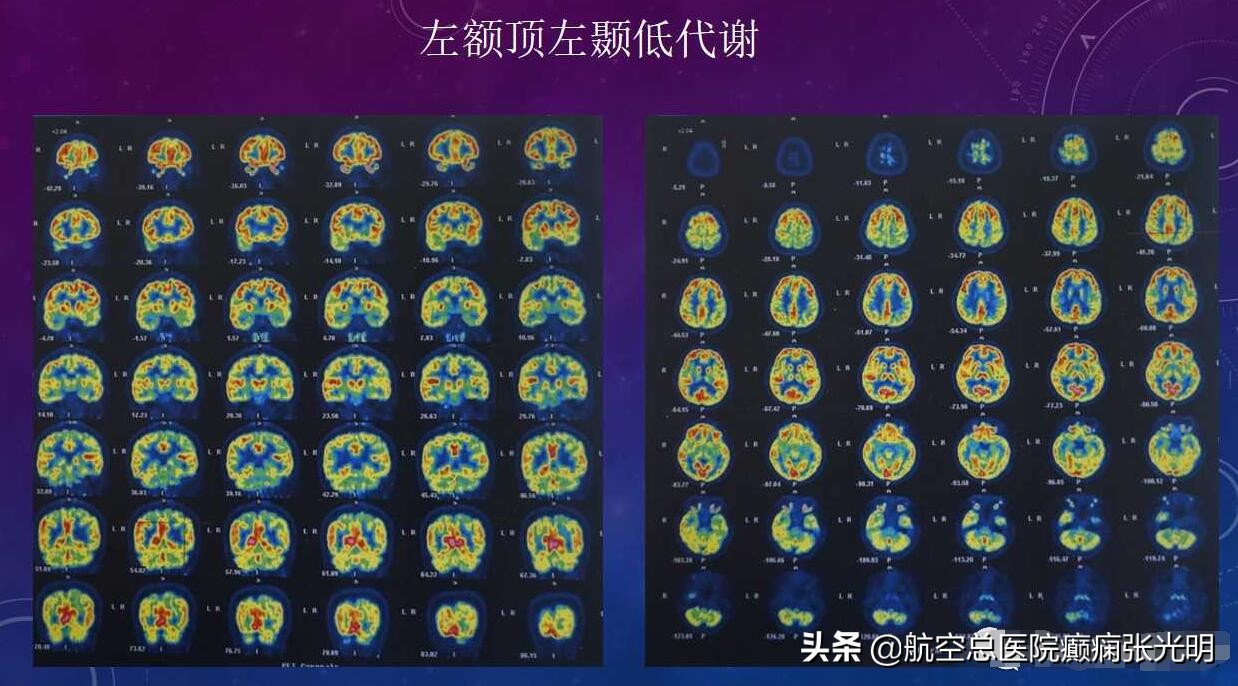 张光明左颞叶癫痫手术成功率,张光明谈治疗癫痫的方法有哪些