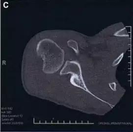 几种严重骨折医学名称,常见的骨折有哪些名称