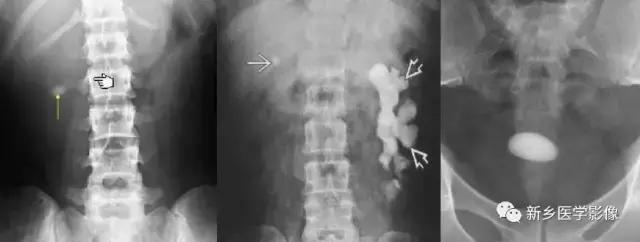 腹部平片能看到结石吗,腹部高密度结节影是什么