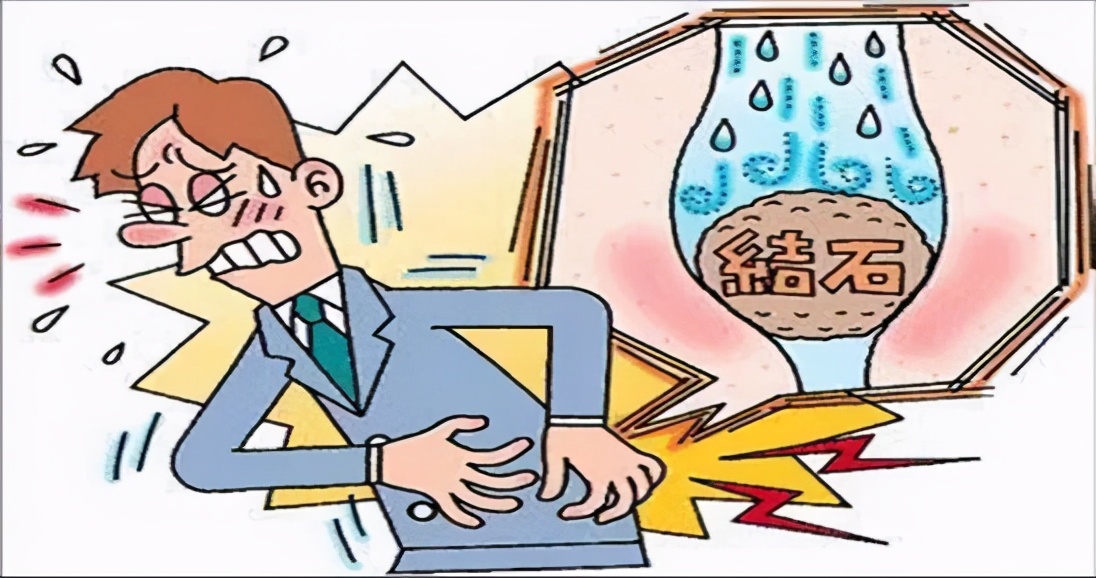 结石多大可以做体外冲击波碎石,男子排石失败肾结石堵输尿管