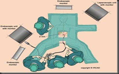 腹腔镜微创手术是做什么的,腹腔镜微创手术治疗啥的
