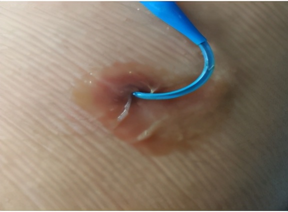 碘伏治疗伤口吗,碘伏治疗伤口发炎吗