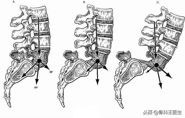 腰椎滑脱可以复位吗,第四腰椎向前滑脱1度可以复位吗
