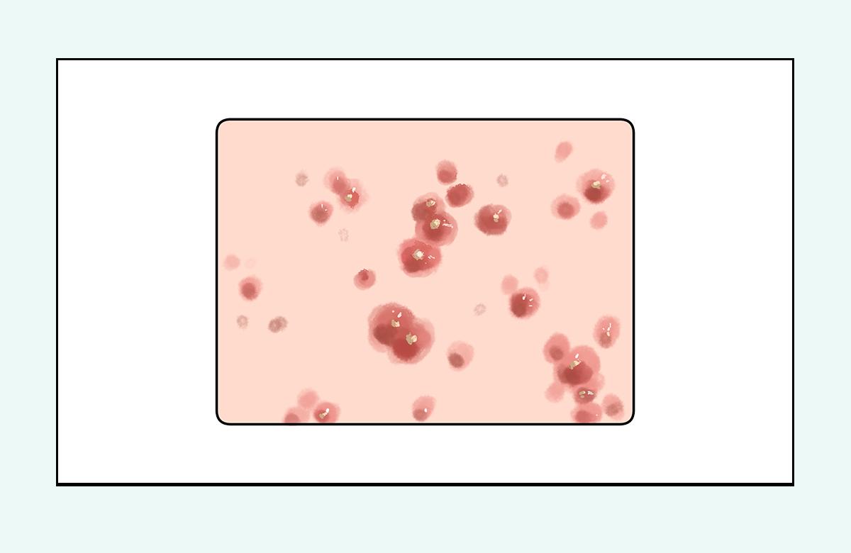 脸上的红疙瘩痒,脸上的红疙瘩用什么药膏