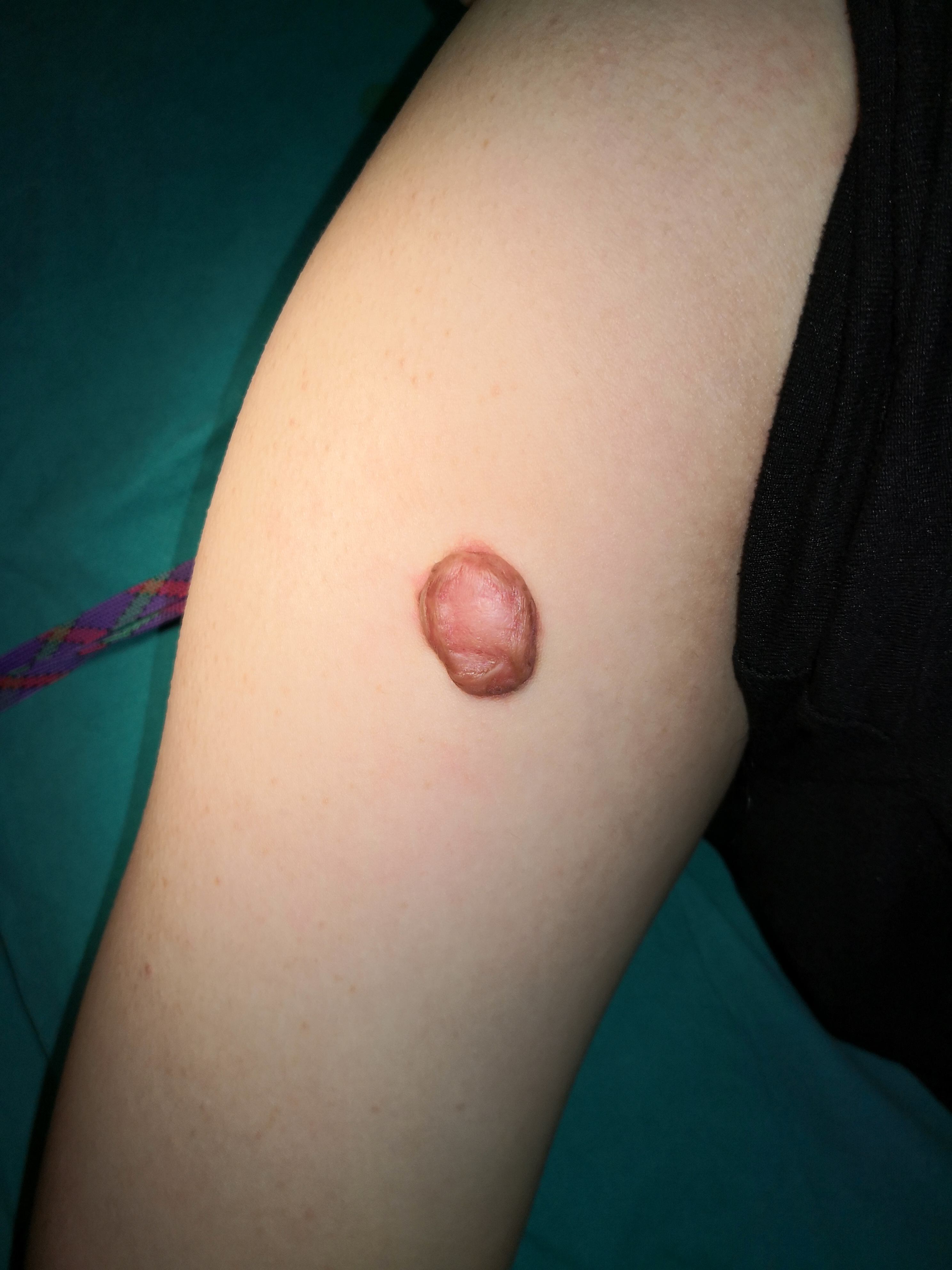 疤痕疙瘩是不是全都建议切除呢？疤痕疙瘩治疗方法